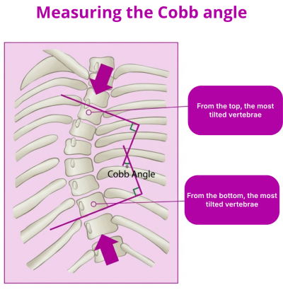 Measuring the cobb angle